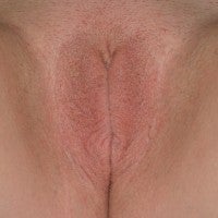 Labiaplasty 571800