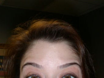 Botox after 295380