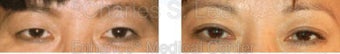 Blepharoplasty before 427717
