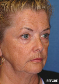 Facelift, Eyelid and Cheek Implant Surgery before 328079