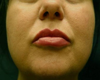 Juvederm Lip Augmentation after 624797