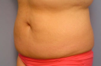 Body Jet and Slim Lipo before 208642
