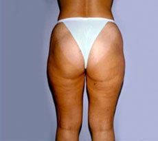 Smartlipo 401653
