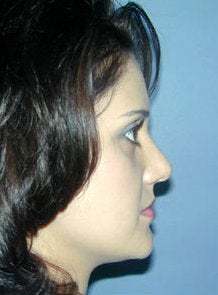 Nose Surgery, Rhinoplasty 550008