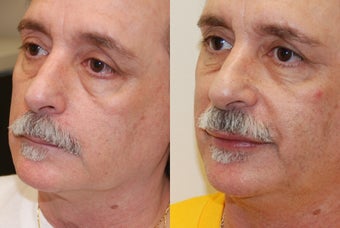 Lip Augmentation with Silikon-1000. before 378275