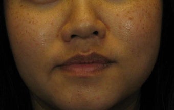 Laser Peels and More Perfect for Ethnic Skin Tones before 628494