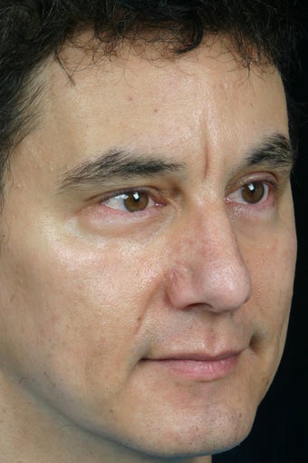 Pearl, Botox and Juvederm to Glabella (between eyes) 308344