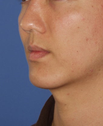 Chin Implant after 414146
