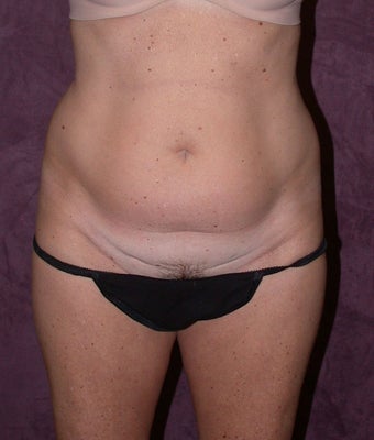 Tummy tuck (abdominoplasty) with liposuction of hips before 94646