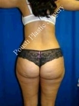 Liposuction 607922