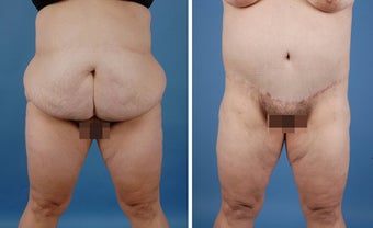 Bilateral Lower Body Lift and Liposuction before 303678