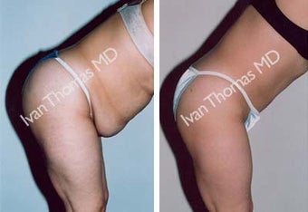 Tummy Tuck before 242531