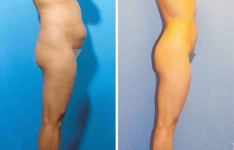 Liposuction before 504997
