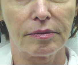 Exilis before 424074