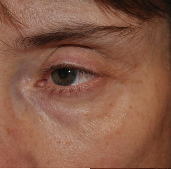 Restylane Injection into the Tear Troughs before 271678