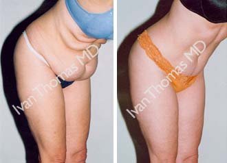 Tummy Tuck before 242524