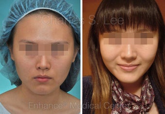 Chin Augmentation, Cheek, Jaw before 431283