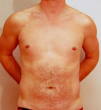 Male Chest Enhancement before 525476