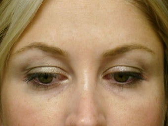 Botox Cosmetic after 375187