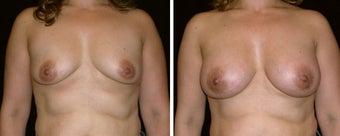 39 year old female, breast augmentation before 628378