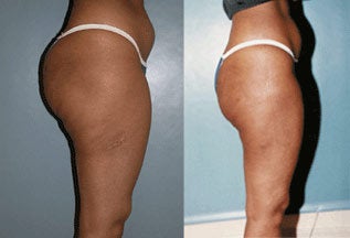 Liposuction before 192164