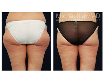 Lower Body Lift 633176