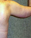 Arm Lift (Brachioplasty) after 142519