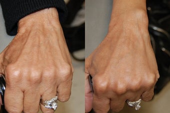 Hand Rejuvenation with Silikon-1000 before 173293