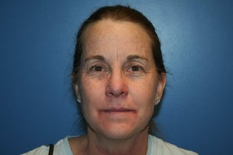 Microlaser Peel, Profractional Laser, and Broad Band Light treament before 526333