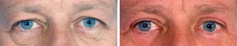 Blepharoplasty before 643236