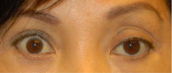 Ptosis Correction before 555502