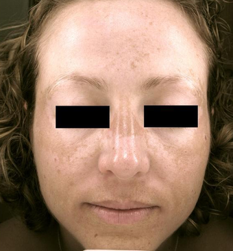 Pro-Fractional plus Chemical Peel before 333391