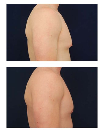Gynecomastia 349235