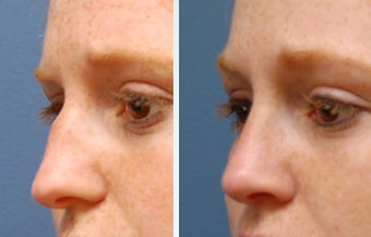 Rhinoplasty before 314278