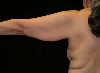 Arm Lift before 609007