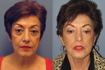 Lite Lift, neck lift, eyelid lift before 523456