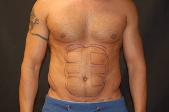 Liposculpting of the abdomen before 319829