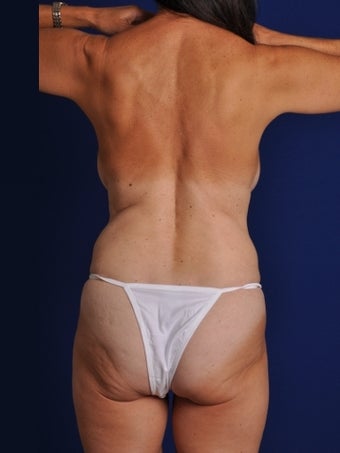 Vaser Hi Def Liposuction of abdomen, thighs, flanks and back with fat injections to buttocks before 422731