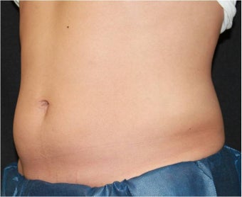 CoolSculpting 421630