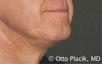 Cervicoplasty 567302