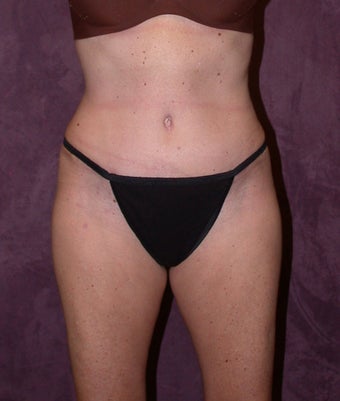 Tummy tuck (abdominoplasty) with liposuction of hips after 94646