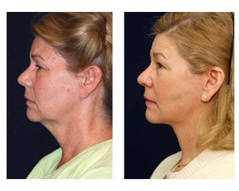 Lower Face and Neck Lift after 355159