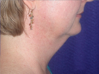 Necklift 208455