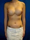 Revision Breast Surgery 356579