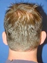Ear Surgery (Otoplasty) 584567