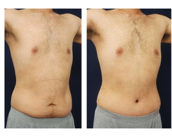 Abdominoplasty - Tummy Tuck after 396153