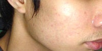 Acne Treatment with Smoothbeam after 271996