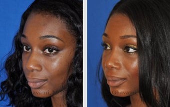 African American Ethnic Rhinoplasty 487997
