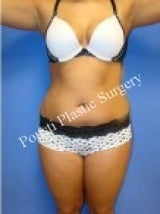 Liposuction before 632168