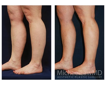 Liposuction after 397064